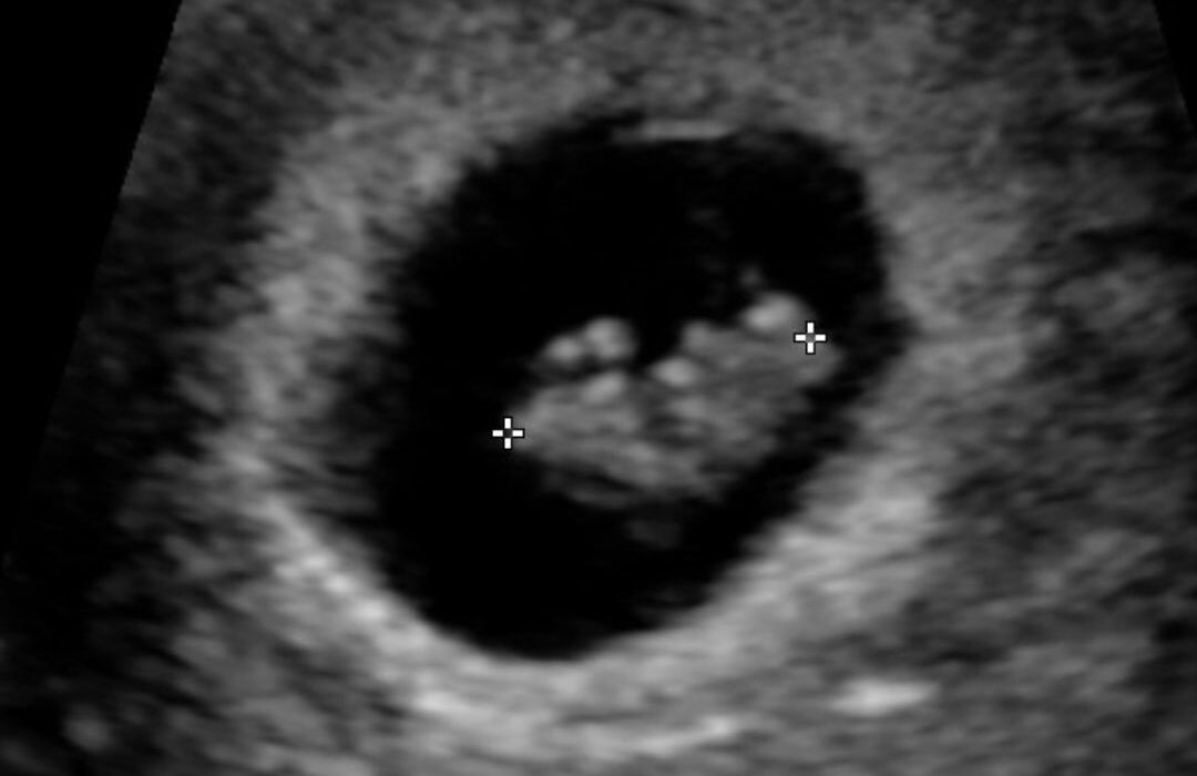 Four Women. Four Unborn Babies. One Powerful God